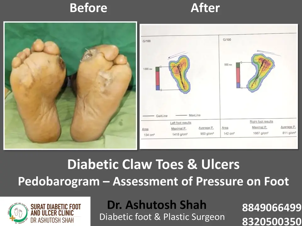 Diabetic Foot  PPT sunita.pptx-27.webp